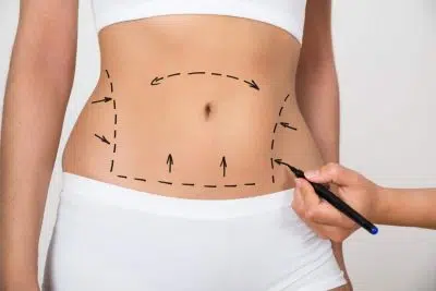 Quelle est la différence entre la liposuccion et lipoaspiration ?