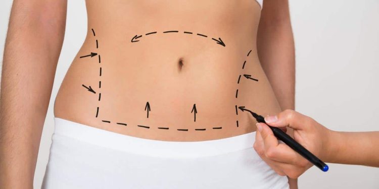 Quelle est la différence entre la liposuccion et lipoaspiration ?
